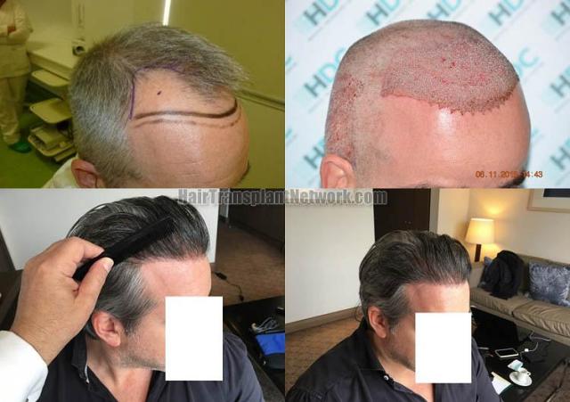 Hair transplantation surgery before and after images