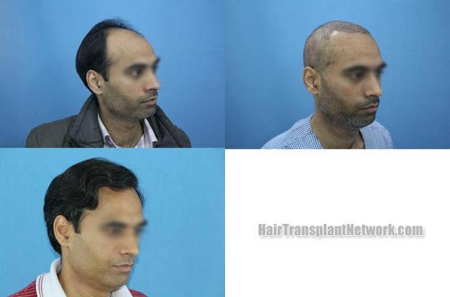 Hair restoration procedure after result images