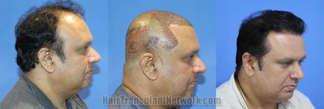 Hair restoration procedure before and after results