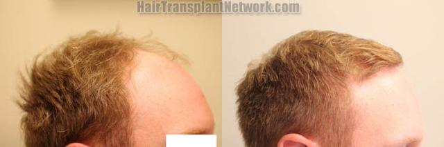 Hair transplantation procedure before and after results