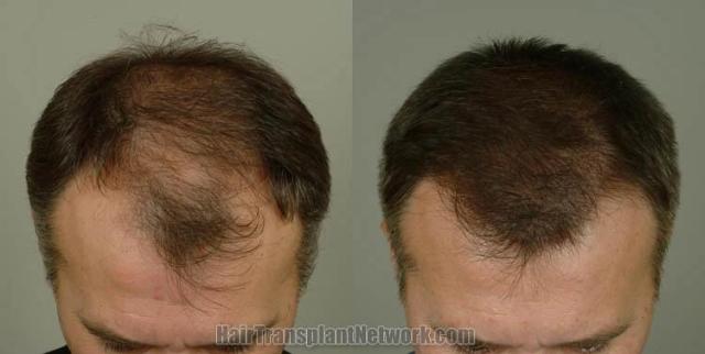 Hair restoration procedure before and after results