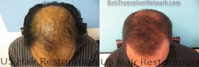 Top view before and after hair restoration results