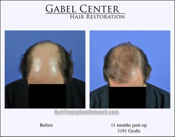 Hair transplantation surgery before and after photos