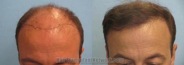 Top view - Before and after surgical hair replacement