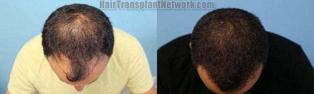 Top view - Before and after surgical hair replacement