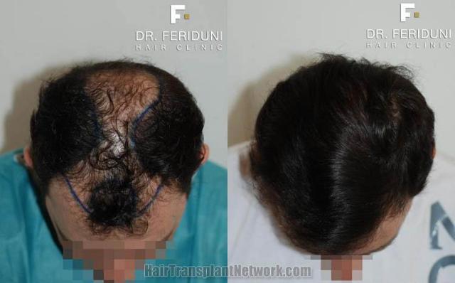 Hair transplantation surgery before and after photos