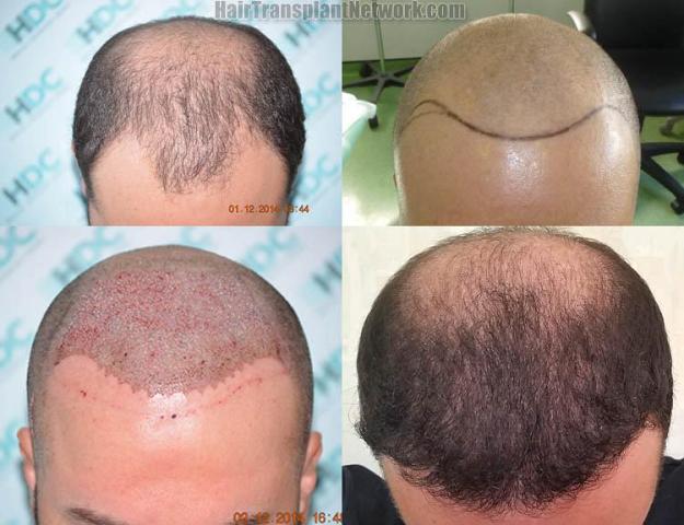 Top view before and after hair restoration results