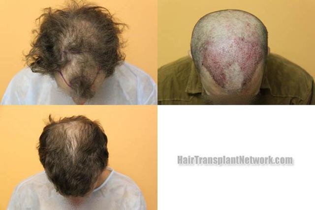 Hair transplantation surgery before and after photos