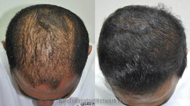 Top view before and after hair restoration results