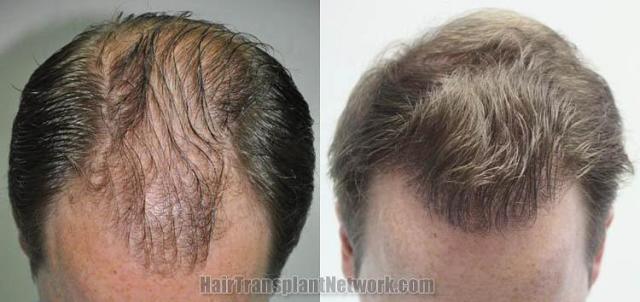 Top view before and after hair restoration results