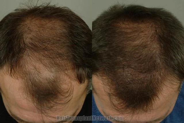 Hair transplantation surgery before and after images