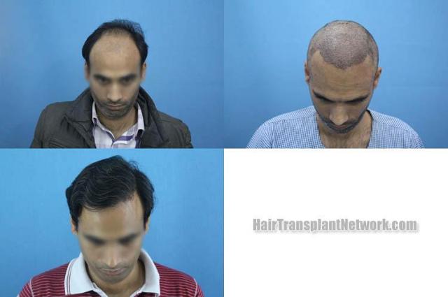 Before and after hair restoration procedure images