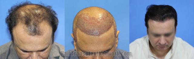 Hair transplantation surgery before and after images