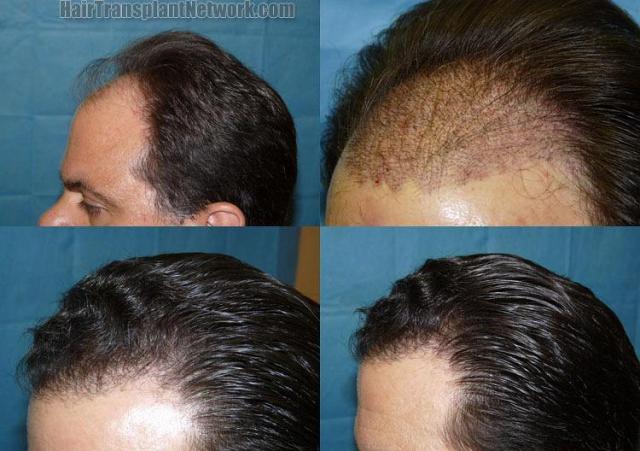 Left view hair transplantation result photographs