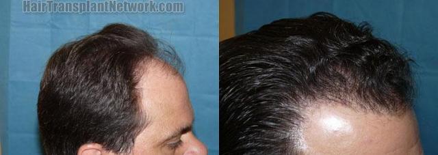 Hair transplant before and after result photos