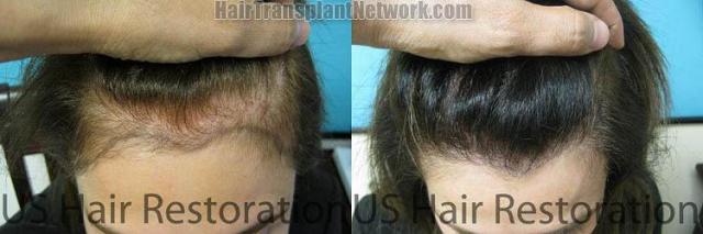 Top view before and after hair restoration results