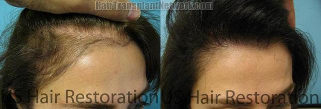 Hair restoration procedure before and after pictures