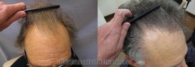 Hair transplantation surgery before and after images