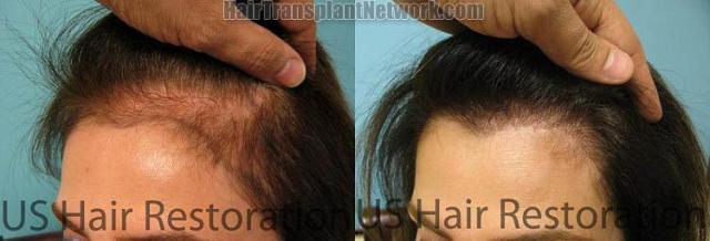 Surgical hair transplantation result photographs