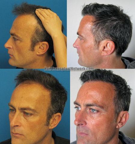 Hair restoration procedure before and after pictures