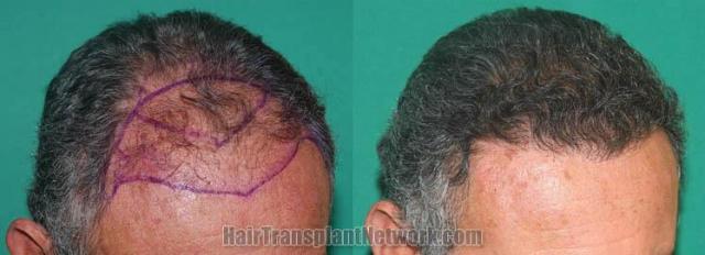 Hair transplantation surgery before and after pictures