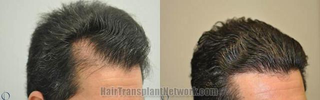 Hair transplantation surgery before and after images