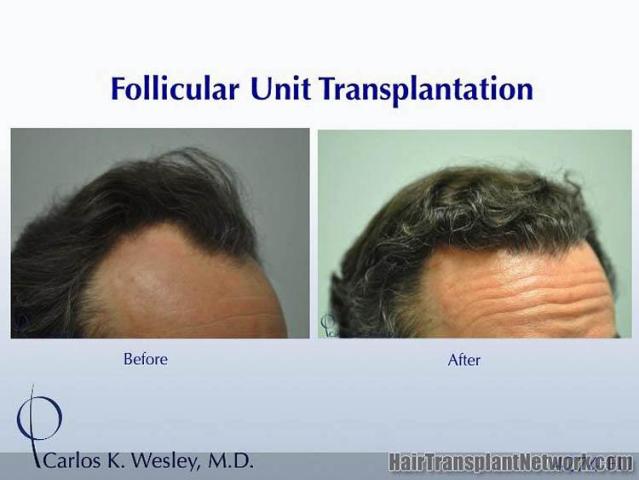 Hair transplant surgery before and after images