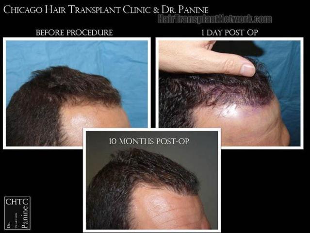 Hair transplantation surgery before and after pictures