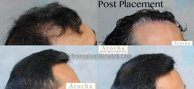 Hair restoration procedure before and after results