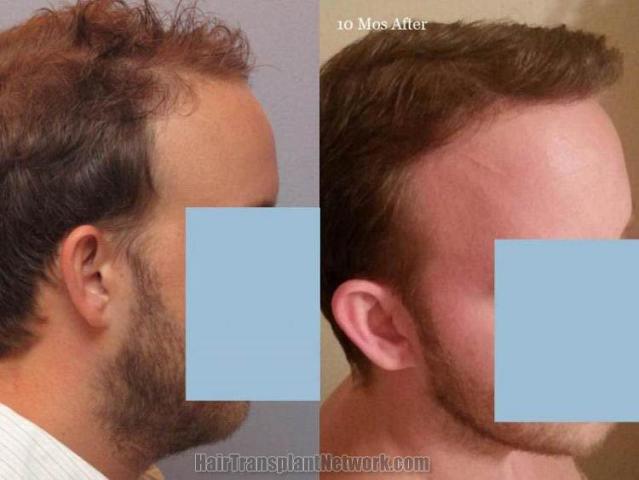 Hair transplantation surgery before and after images