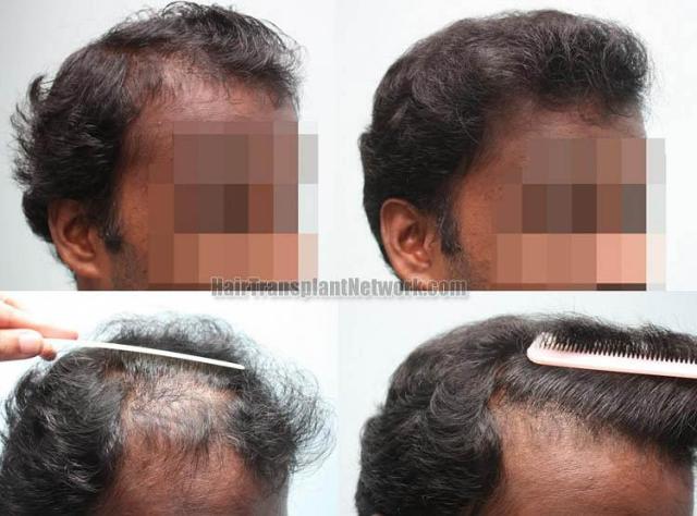 Hair transplantation surgery before and after images