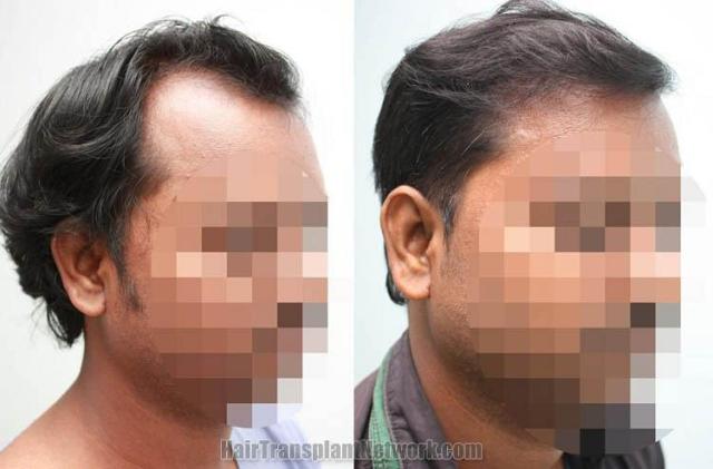 Hair transplantation surgery before and after pictures