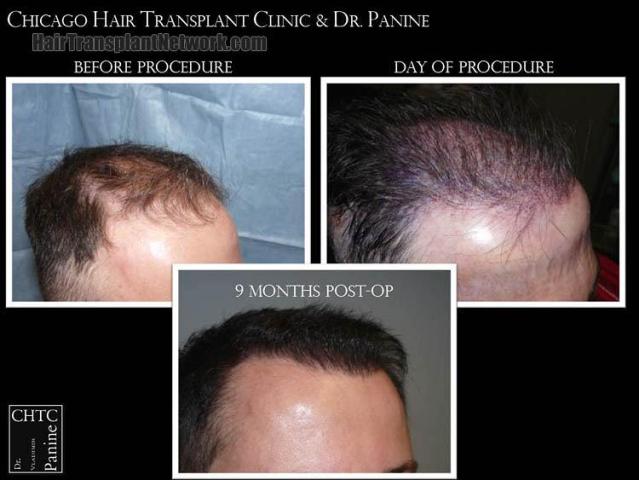 Hair transplantation surgery before and after images