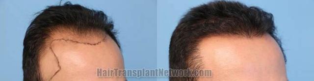 Hair transplantation surgery before and after images