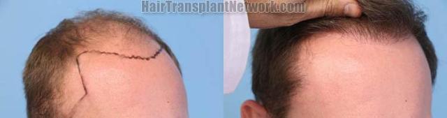 Hair transplantation surgery before and after images