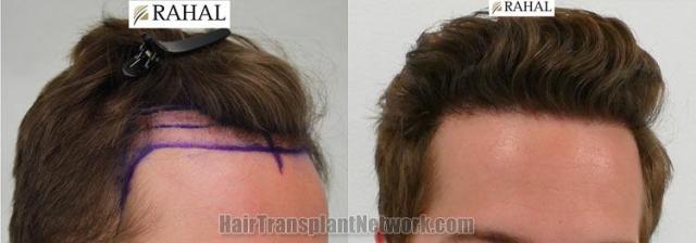 Hair restoration procedure before and after results