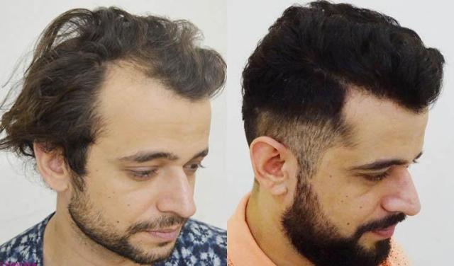 Hair transplantation procedure before and after results