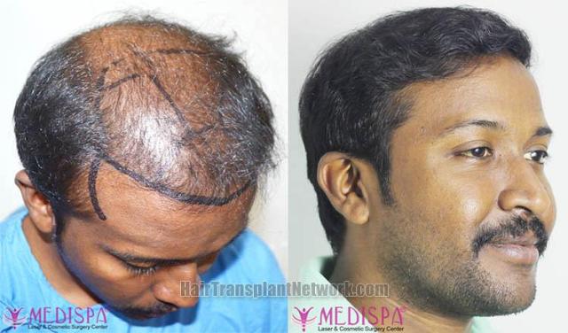 Hair restoration procedure after result images