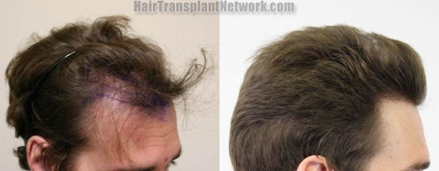 Hair transplantation procedure before and after results