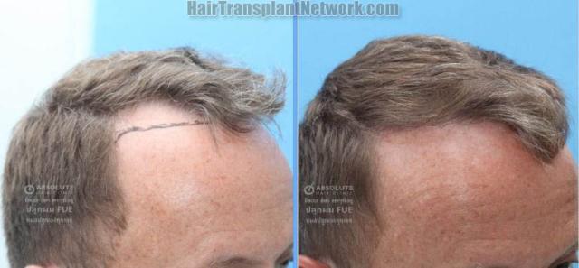 Hair transplantation procedure before and after results