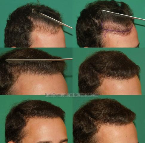 Hair restoration procedure after result images