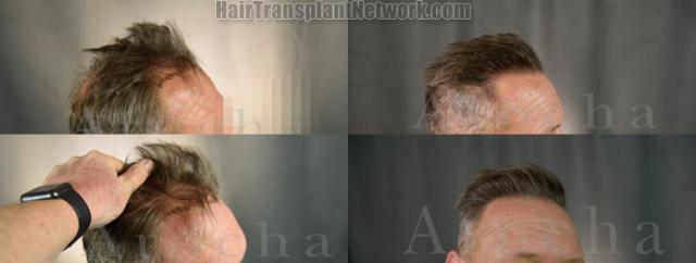 Hair transplantation procedure before and after results