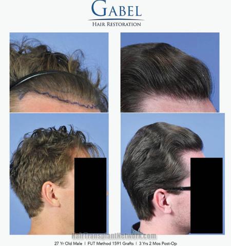 Hair transplantation procedure before and after results