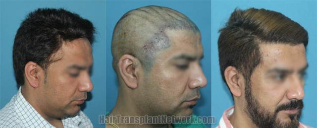 Hair transplantation procedure before and after results