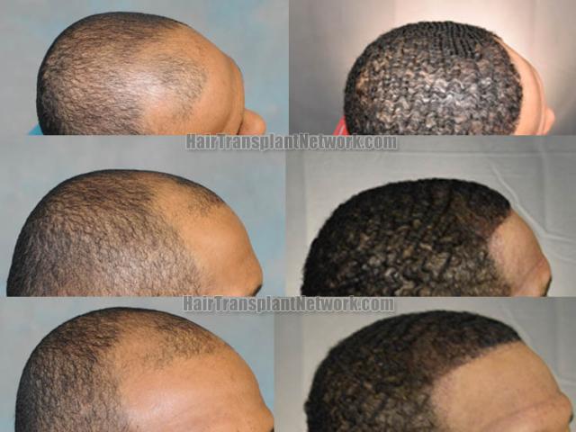 Hair restoration procedure before and after results