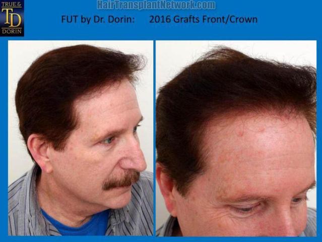 Hair transplant surgery before and after photos