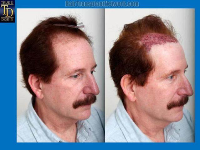 Hair transplantation surgery before and after images