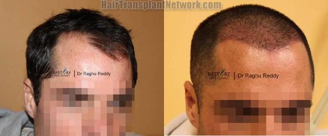 Hair transplantation surgery before and after images