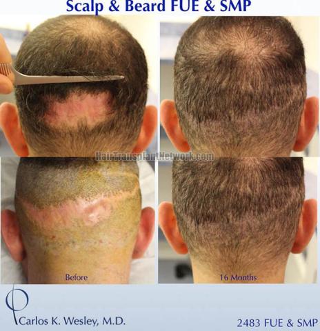 Hair transplantation procedure before and after photographs