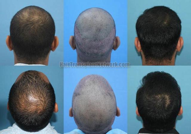 Hair replacement surgery before and after images